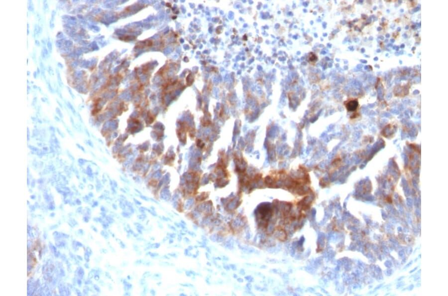 Immunohistochemistry - Anti-TAG72 Antibody [B72.3 + CC49] (A248361) - Antibodies.com