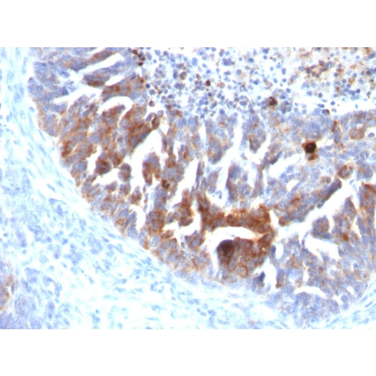 Immunohistochemistry - Anti-TAG72 Antibody [B72.3 + CC49] (A248361) - Antibodies.com