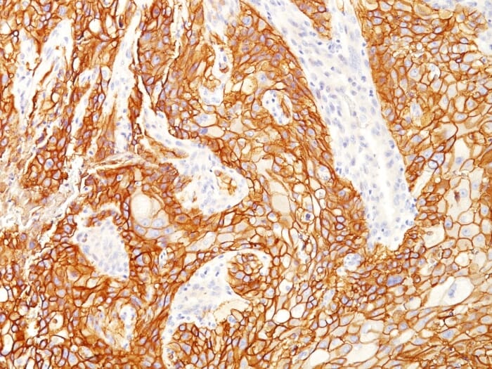 Immunohistochemical analysis of formalin-fixed, paraffin-embedded human lung squamous cell carcinoma using Anti-EGFRvIII Antibody [GFR/2600R].