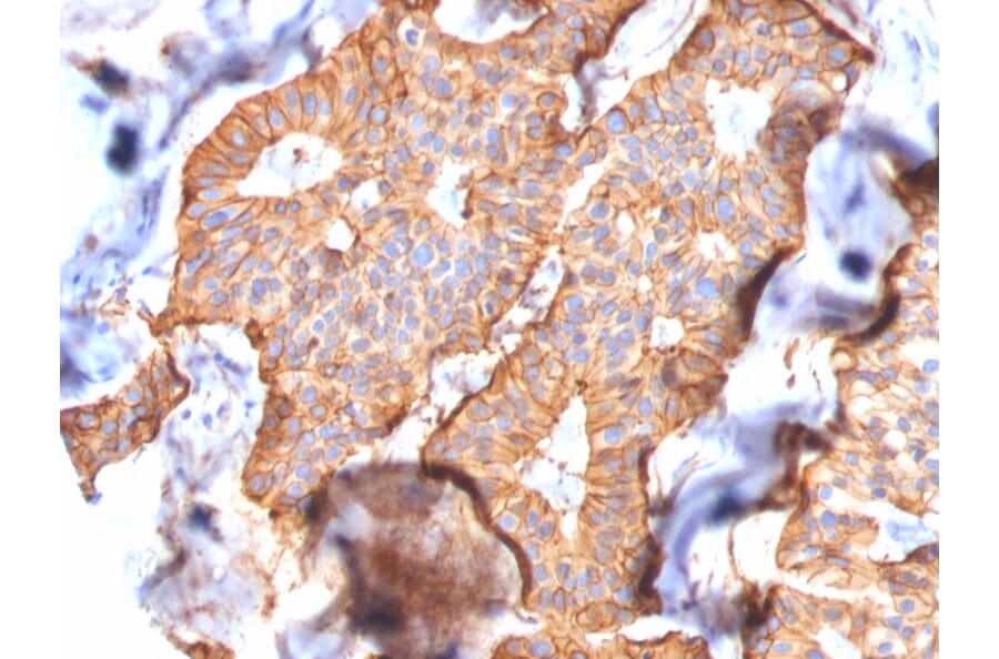 Immunohistochemistry - Anti-HER2 Antibody [SPM172] (A251641) - Antibodies.com