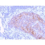 Immunohistochemistry - Anti-HER2 Antibody [ERBB2/3078] (A248446) - Antibodies.com