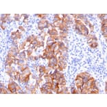 Immunohistochemistry - Anti-HER2 Antibody [ERBB2/3093] (A248451) - Antibodies.com