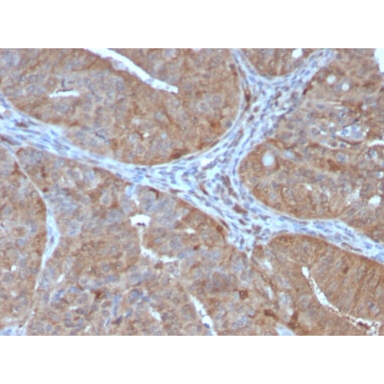 Immunohistochemistry - Anti-AKR1B1 Antibody [CPTC-AKR1B1-2] (A248570) - Antibodies.com