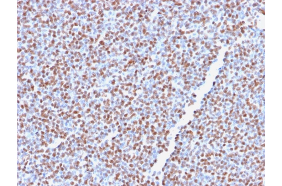 Immunohistochemistry - Anti-ALK Antibody [ALK1/2766R] (A248625) - Antibodies.com