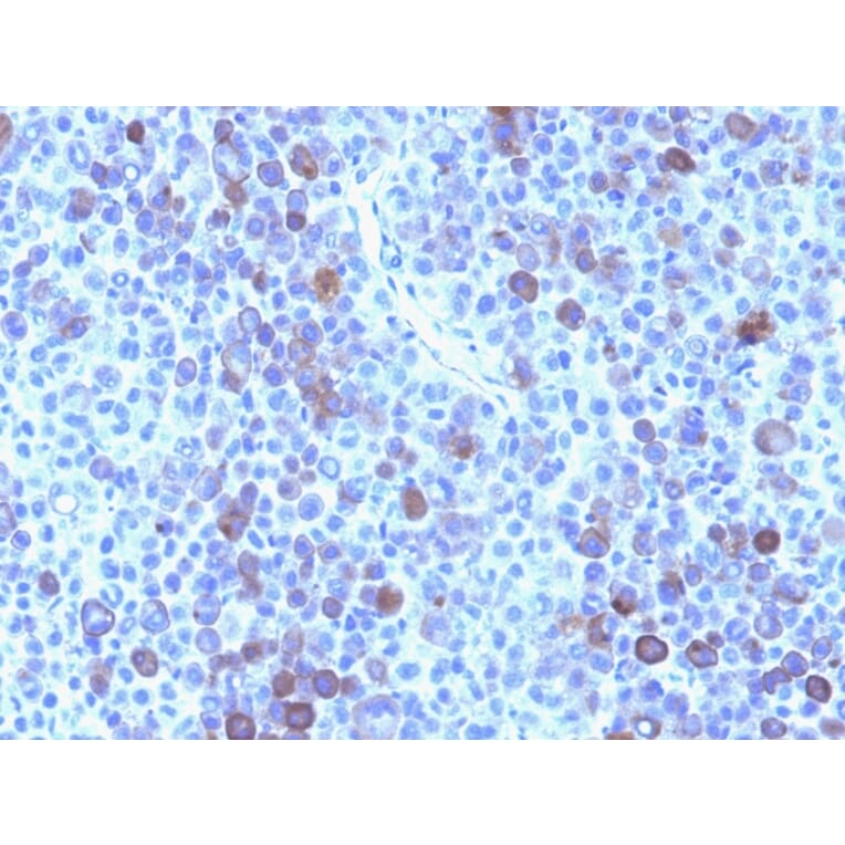 Immunohistochemistry - Anti-Glypican 3 Antibody [GPC3/863] (A248729) - Antibodies.com