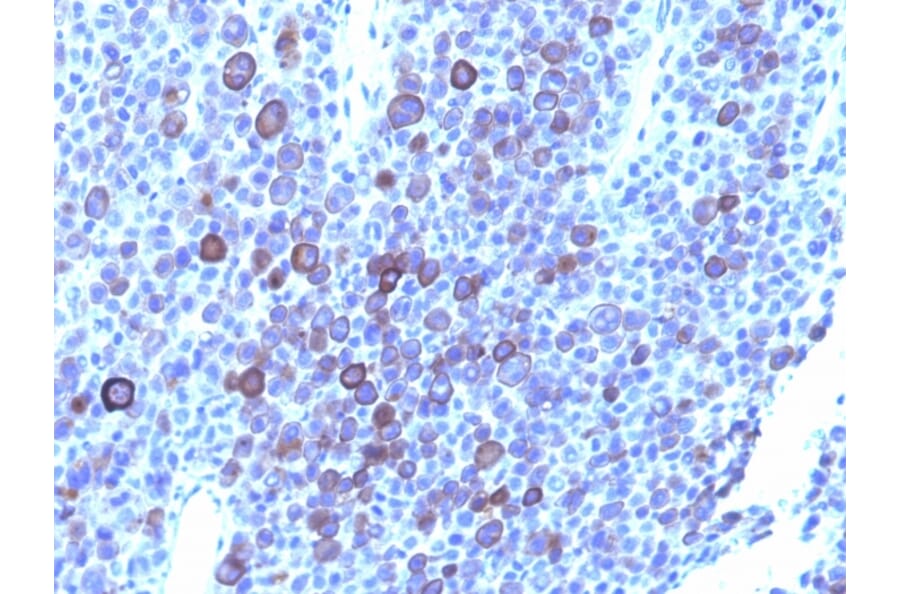 Immunohistochemistry - Anti-Glypican 3 Antibody [1G12 + GPC3/863] (A248730) - Antibodies.com