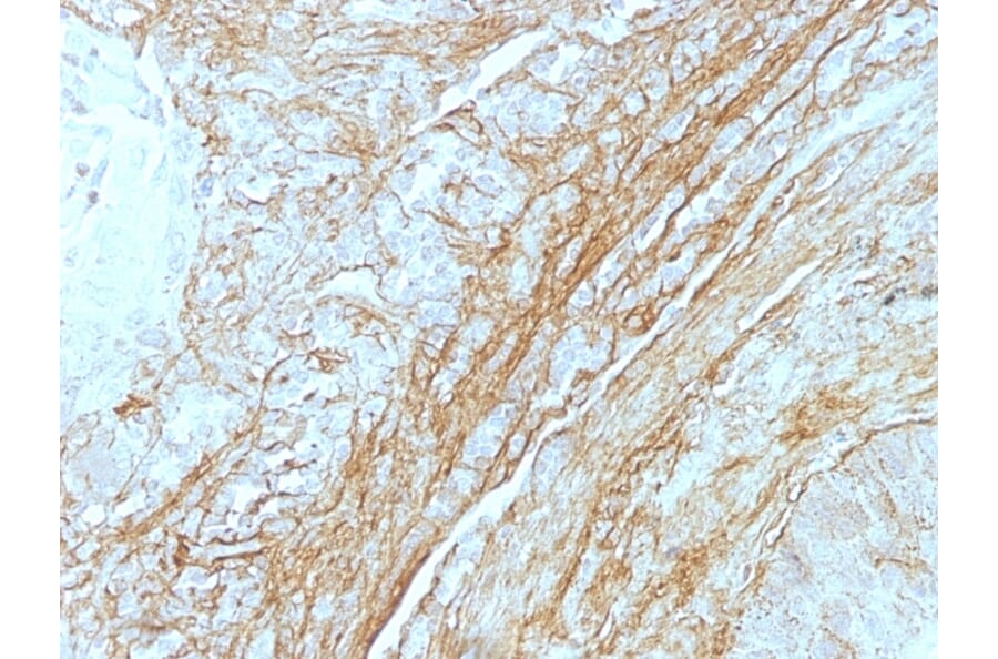 Immunohistochemistry - Anti-Tenascin C Antibody [T2H5] (A248896) - Antibodies.com