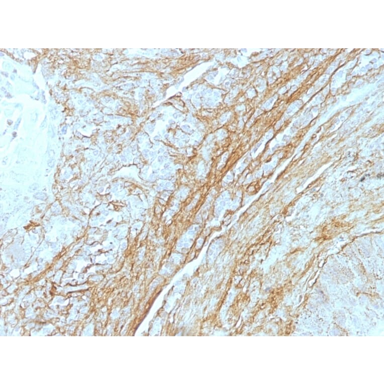 Immunohistochemistry - Anti-Tenascin C Antibody [T2H5] (A248896) - Antibodies.com