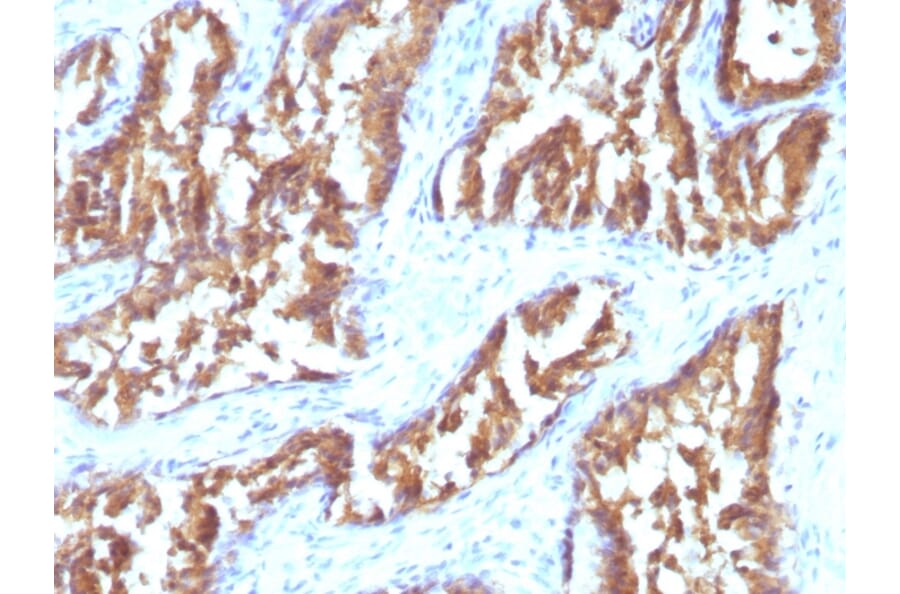 Immunohistochemistry - Anti-IDH1 Antibody [IDH1/1152] (A248916) - Antibodies.com