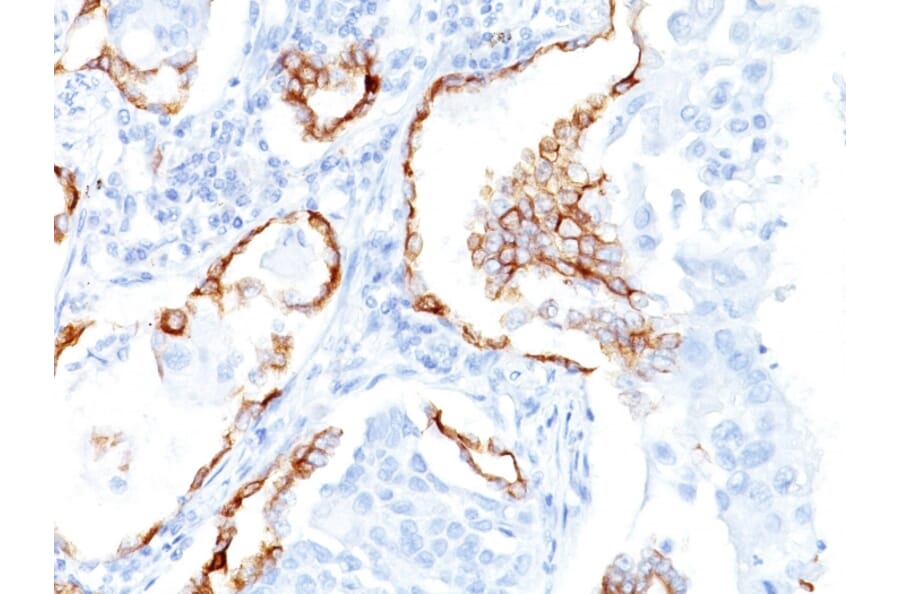 Immunohistochemistry - Anti-Cytokeratin 7 Antibody [K72.7] (A249137) - Antibodies.com