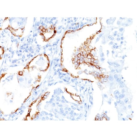 Immunohistochemistry - Anti-Cytokeratin 7 Antibody [K72.7] (A249137) - Antibodies.com