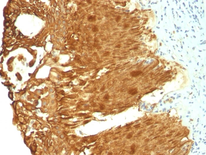 Immunohistochemical analysis of formalin-fixed, paraffin-embedded human cervical carcinoma using Anti-Cytokeratin 19 Antibody [KRT19/799 + KRT19/800].