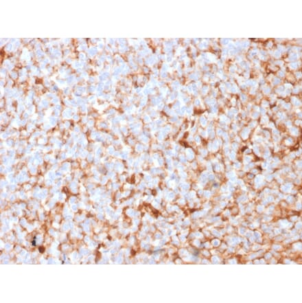 Immunohistochemistry - Anti-Mammaglobin A Antibody [SPM518] (A249320) - Antibodies.com