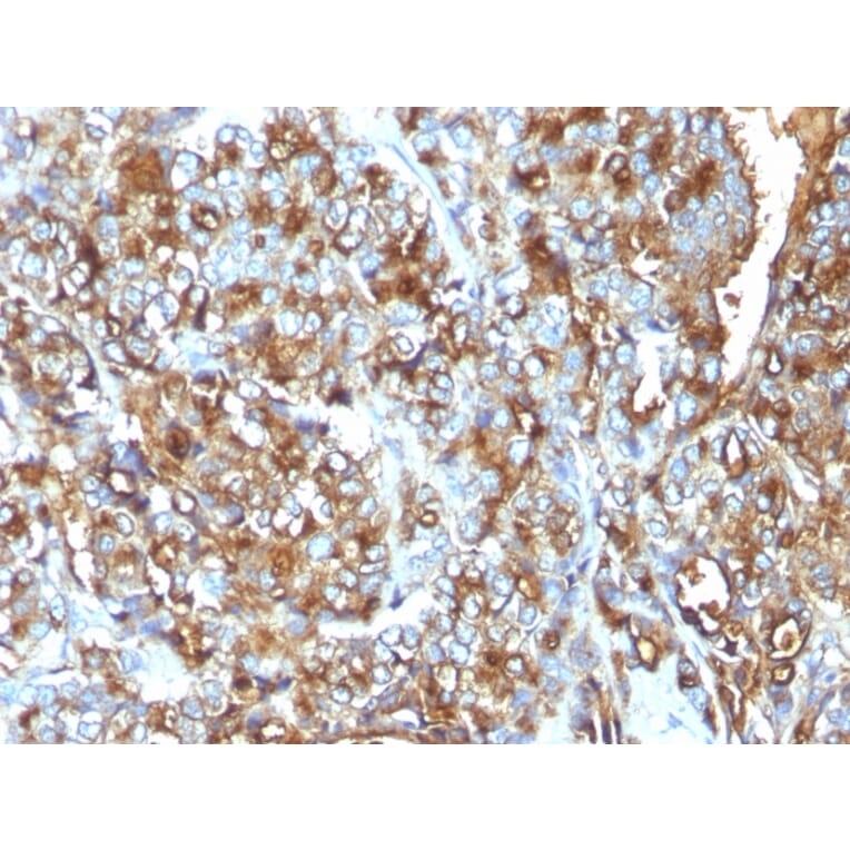 Immunohistochemistry - Anti-MUC1 Antibody [MUC1/520] (A249398) - Antibodies.com