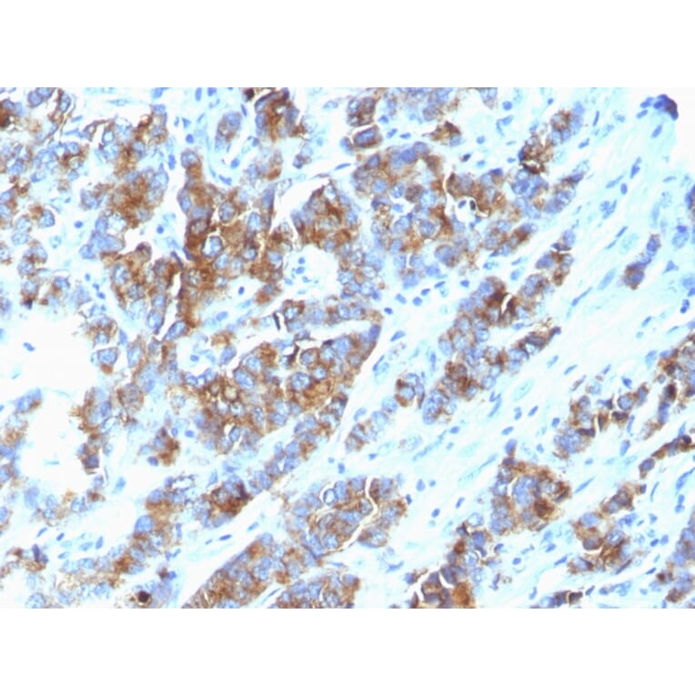 Immunohistochemistry - Anti-MUC1 Antibody [SPM533] (A252581) - Antibodies.com