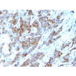 Immunohistochemistry - Anti-MUC1 Antibody [SPM533] (A252581) - Antibodies.com