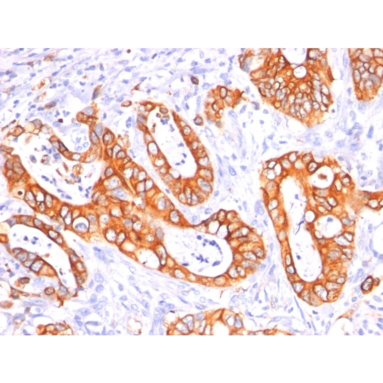 Immunohistochemistry - Anti-MUC1 Antibody [GP1.4 + E29] (A249405) - Antibodies.com