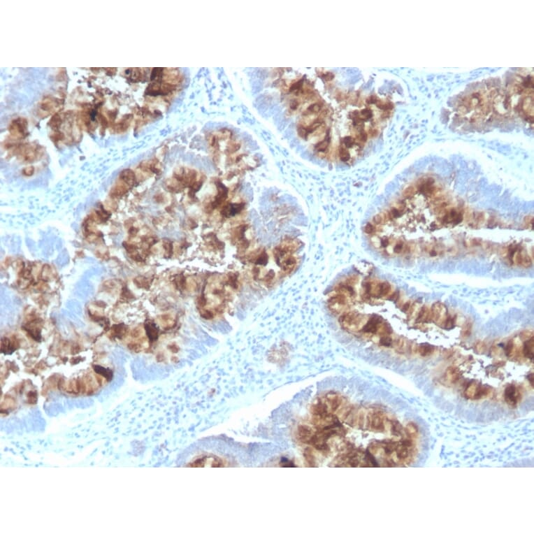 Immunohistochemistry - Anti-MUC1 Antibody [MUC1/2818R] (A249414) - Antibodies.com