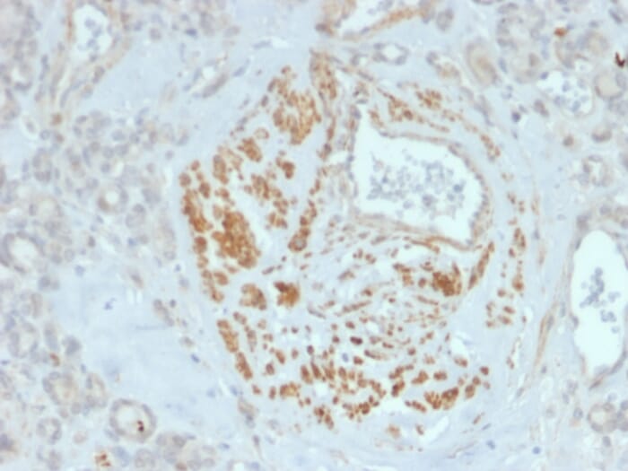 Immunohistochemical analysis of formalin-fixed, paraffin-embedded human breast using Anti-HOMEZ Antibody [PCRP-HOMEZ-1B5].