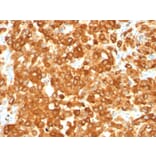 Immunohistochemistry - Anti-Melanoma gp100 Antibody [HMB45] (A249966) - Antibodies.com