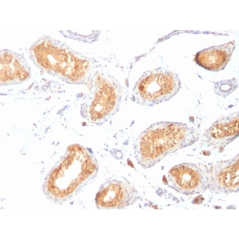 Immunohistochemistry - Anti-Melanoma gp100 Antibody [HMB45] (A249967) - Antibodies.com