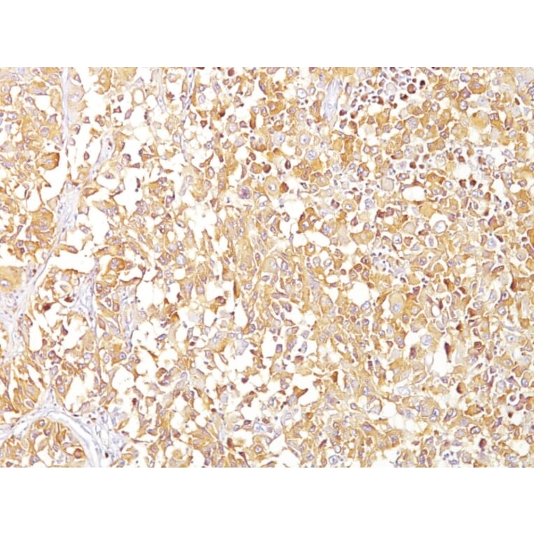 Immunohistochemistry - Anti-Melanoma gp100 Antibody [SPM142] (A249968) - Antibodies.com