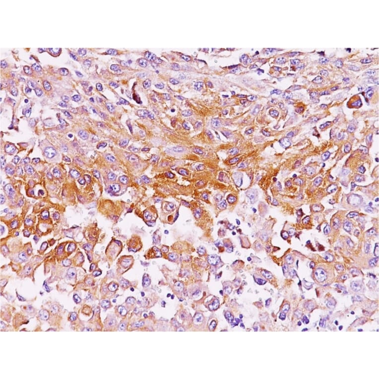 Immunohistochemistry - Anti-Melanoma gp100 Antibody [NKI-beteb] (A249969) - Antibodies.com