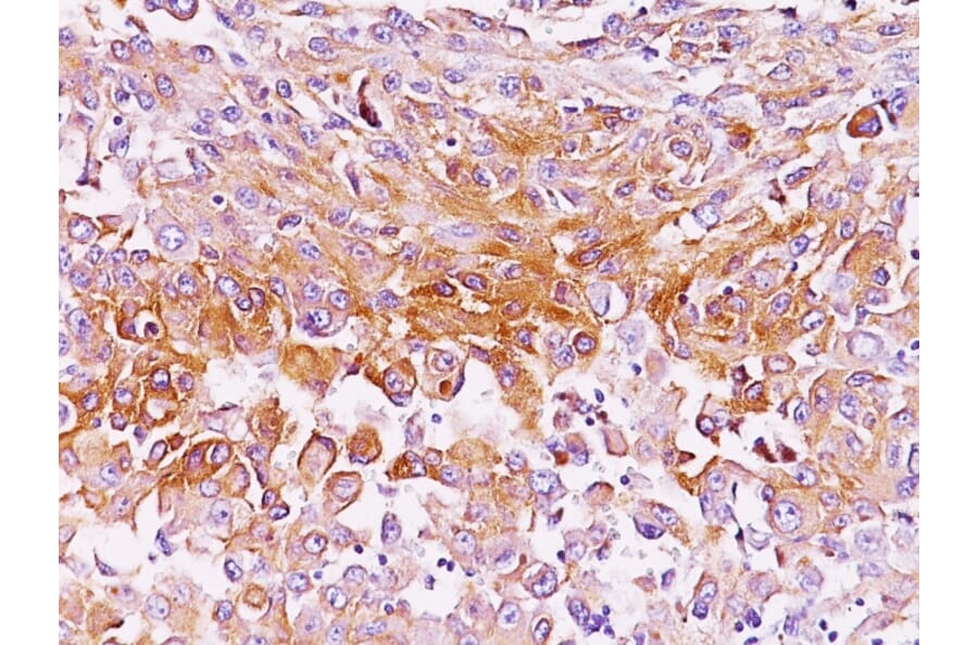 Immunohistochemistry - Anti-Melanoma gp100 Antibody [SPM286] (A249969) - Antibodies.com