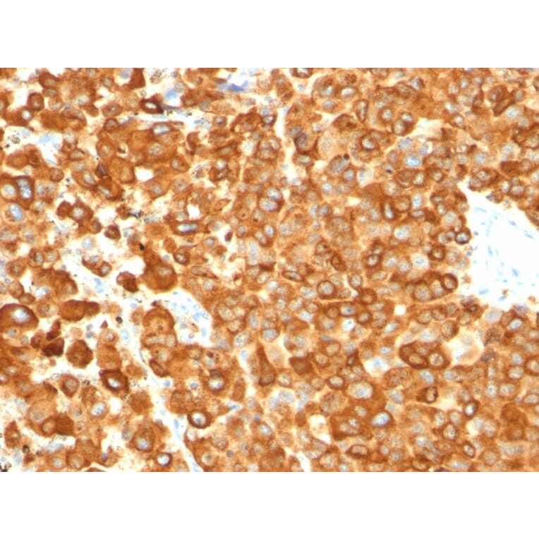 Immunohistochemistry - Anti-Melanoma gp100 Antibody [PMEL/783] (A249970) - Antibodies.com