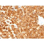 Immunohistochemistry - Anti-Melanoma gp100 Antibody [PMEL/783] (A249970) - Antibodies.com