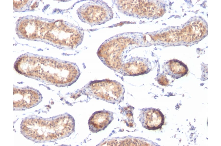 Immunohistochemistry - Anti-Melanoma gp100 Antibody [PMEL/783] (A249971) - Antibodies.com