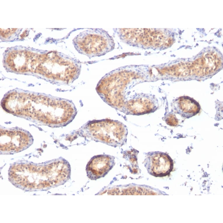 Immunohistochemistry - Anti-Melanoma gp100 Antibody [PMEL/783] (A249971) - Antibodies.com