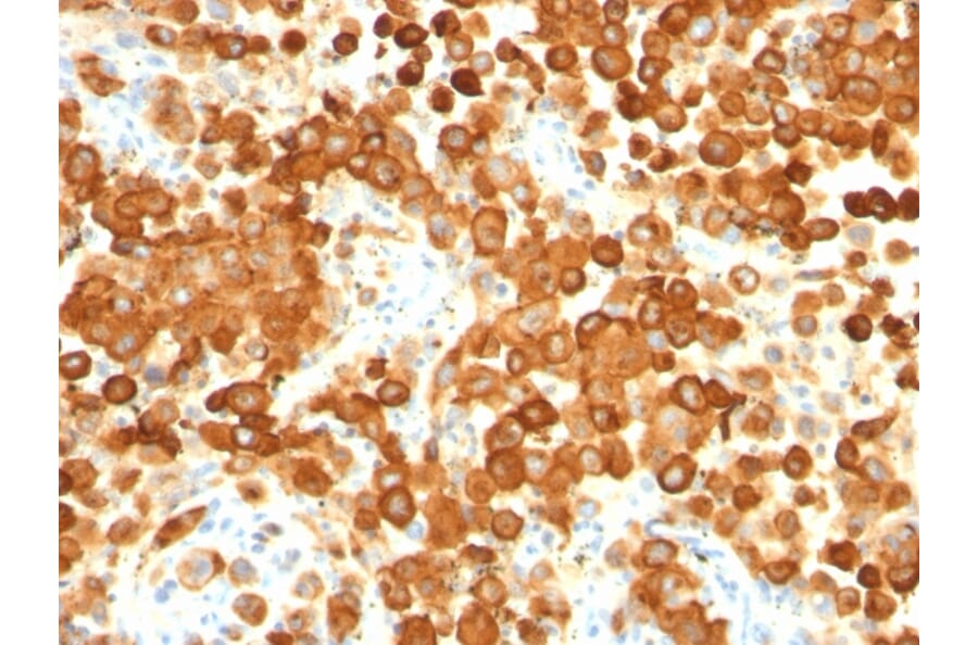 Immunohistochemistry - Anti-Melanoma gp100 Antibody [HMB45 + PMEL/783] (A249971) - Antibodies.com
