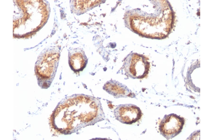 Immunohistochemistry - Anti-Melanoma gp100 Antibody [HMB45 + PMEL/783] (A249972) - Antibodies.com