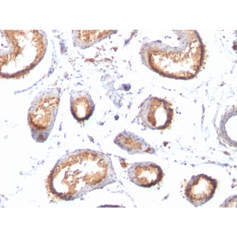 Immunohistochemistry - Anti-Melanoma gp100 Antibody [HMB45 + PMEL/783] (A249972) - Antibodies.com