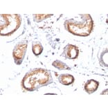 Immunohistochemistry - Anti-Melanoma gp100 Antibody [HMB45 + PMEL/783] (A249972) - Antibodies.com