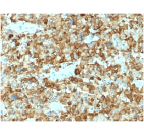 Immunohistochemistry - Anti-Melanoma gp100 Antibody [PMEL/2037] (A249973) - Antibodies.com