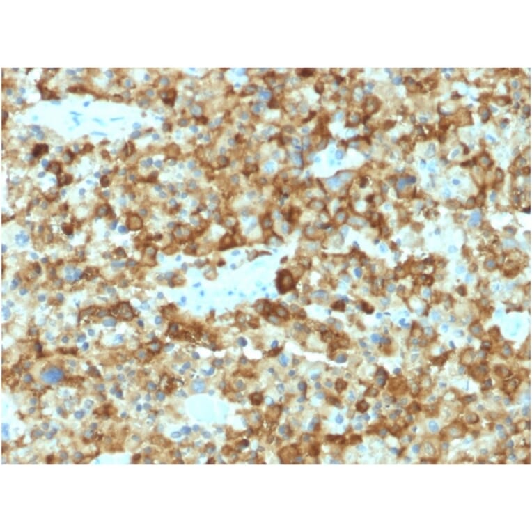 Immunohistochemistry - Anti-Melanoma gp100 Antibody [PMEL/2037] (A249973) - Antibodies.com