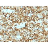 Immunohistochemistry - Anti-Melanoma gp100 Antibody [PMEL/2037] (A249973) - Antibodies.com