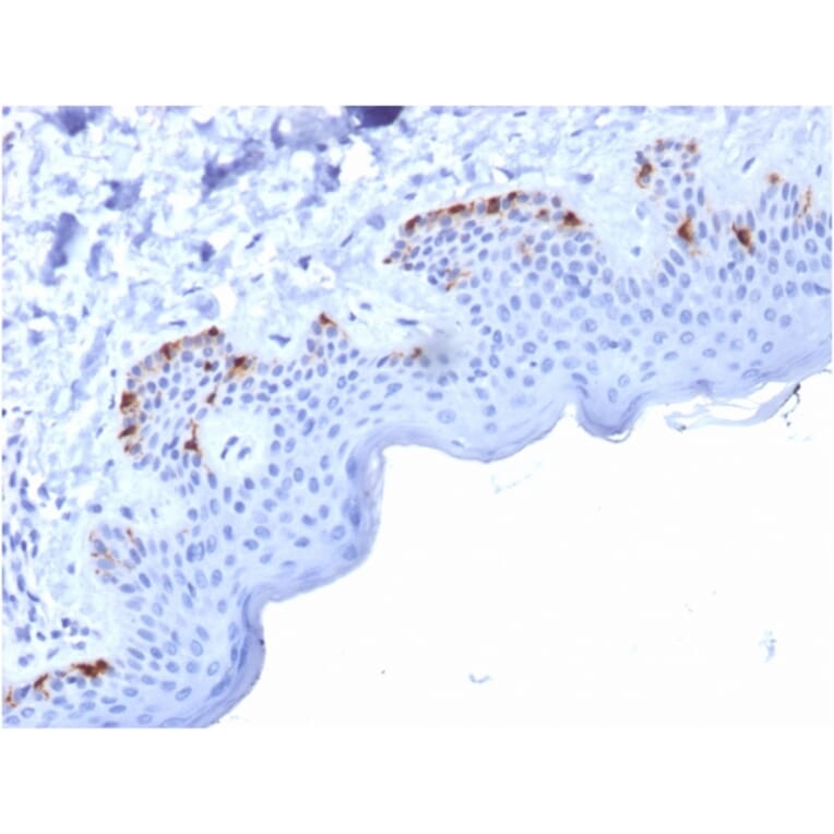 Immunohistochemistry - Anti-Melanoma gp100 Antibody [PMEL/2037] (A249973) - Antibodies.com