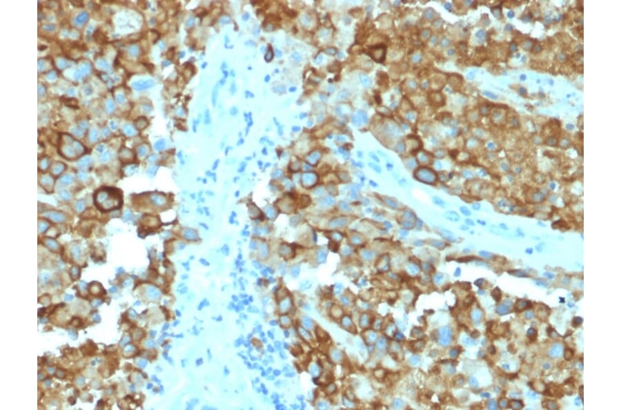 Immunohistochemistry - Anti-Melanoma gp100 Antibody [PMEL/2038] (A249974) - Antibodies.com