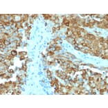 Immunohistochemistry - Anti-Melanoma gp100 Antibody [PMEL/2038] (A249974) - Antibodies.com