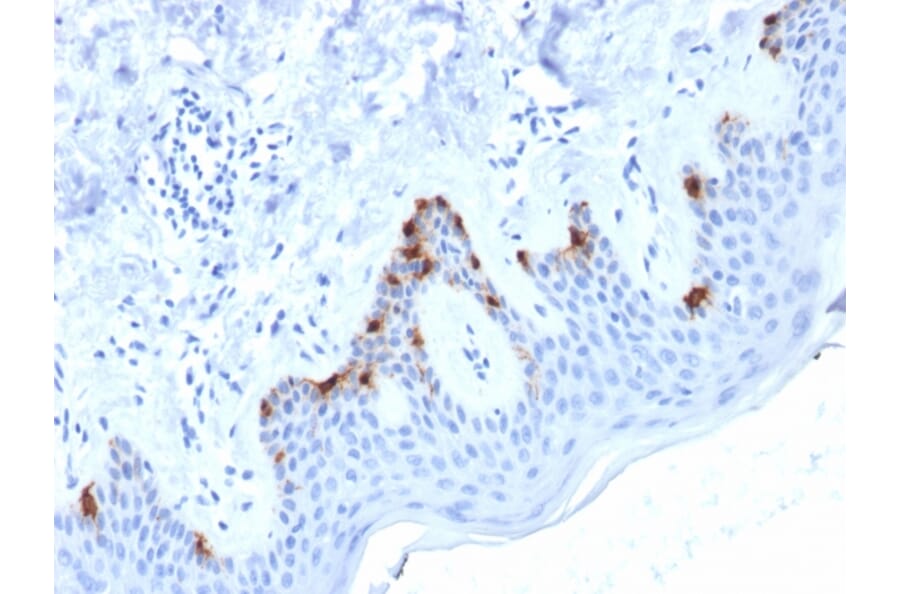 Immunohistochemistry - Anti-Melanoma gp100 Antibody [PMEL/2038] (A249974) - Antibodies.com