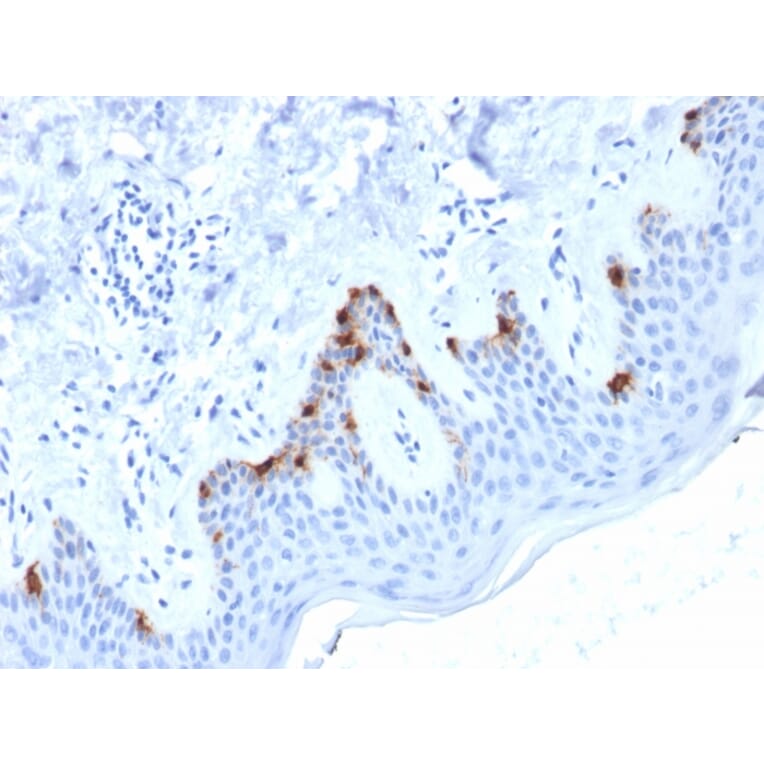 Immunohistochemistry - Anti-Melanoma gp100 Antibody [PMEL/2038] (A249974) - Antibodies.com