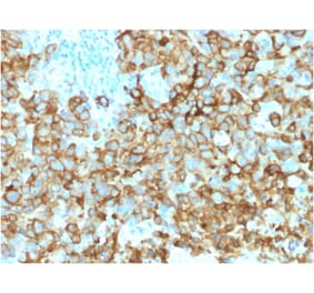 Immunohistochemistry - Anti-Melanoma gp100 Antibody [PMEL/2039] (A249975) - Antibodies.com