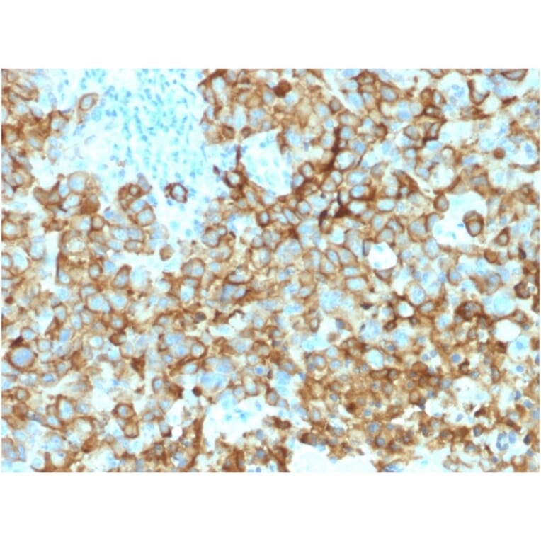 Immunohistochemistry - Anti-Melanoma gp100 Antibody [PMEL/2039] (A249975) - Antibodies.com