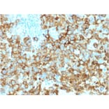 Immunohistochemistry - Anti-Melanoma gp100 Antibody [PMEL/2039] (A249975) - Antibodies.com