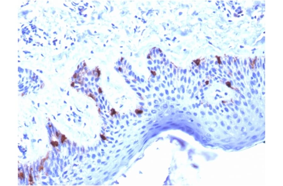 Immunohistochemistry - Anti-Melanoma gp100 Antibody [PMEL/2039] (A249975) - Antibodies.com