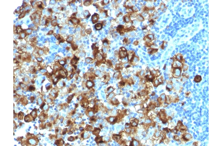 Immunohistochemistry - Anti-Melanoma gp100 Antibody [PMEL/1825R] (A249975) - Antibodies.com