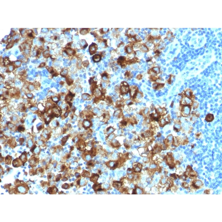 Immunohistochemistry - Anti-Melanoma gp100 Antibody [PMEL/1825R] (A249975) - Antibodies.com